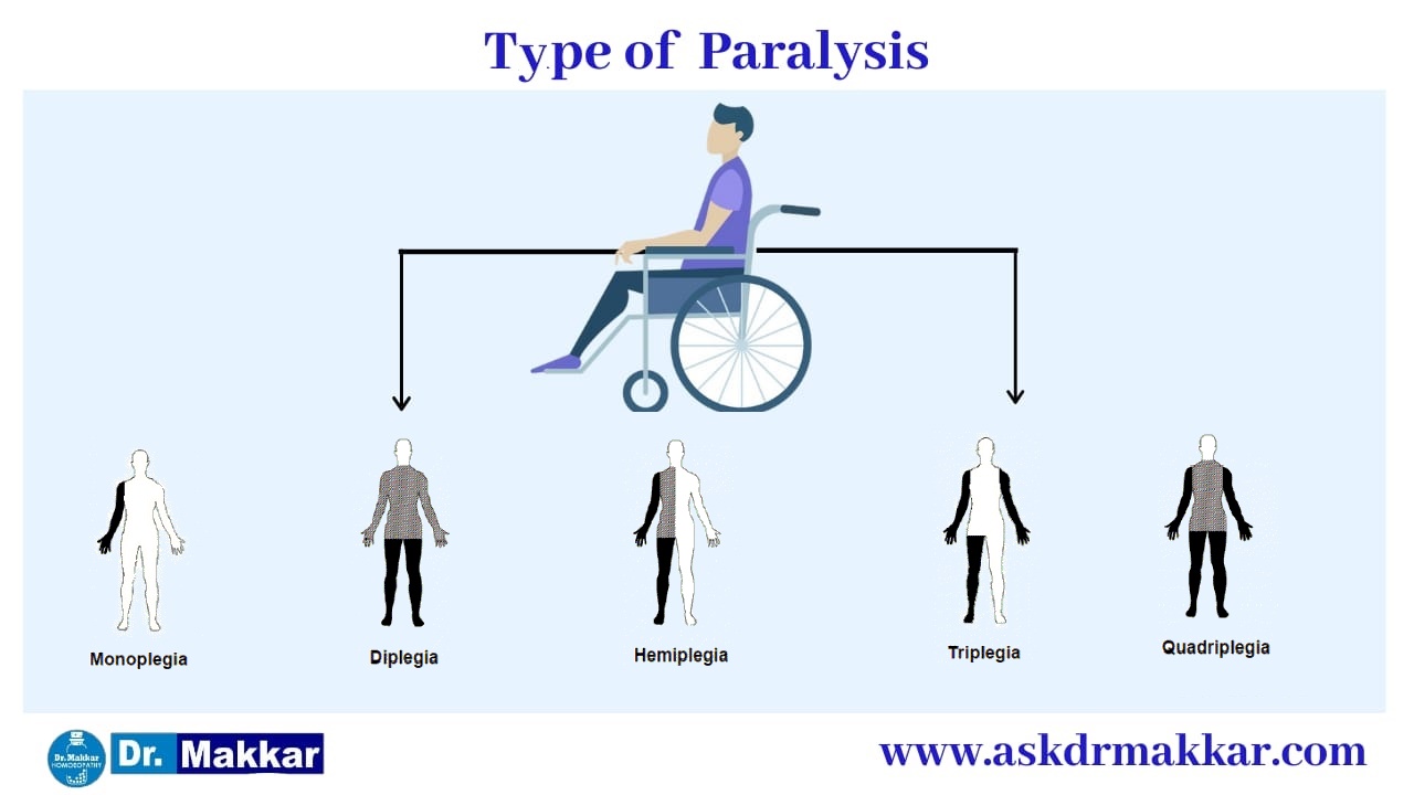 Paraplegia Causes